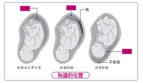 胎盤剝離方式|胎盤早期剝離